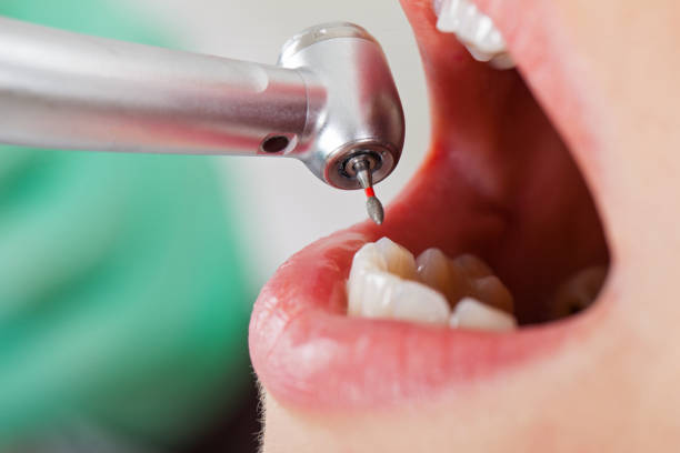 Best Emergency Dental Care for Broken or Chipped Teeth in North Springfield, VA